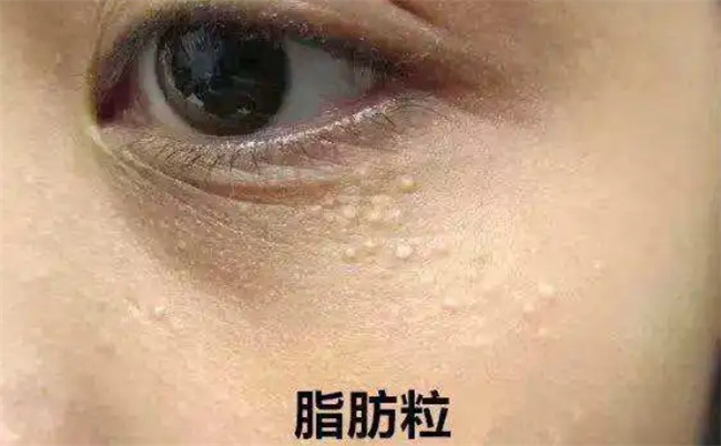 ​怎样去除眼部脂肪粒，脂肪粒是怎么形成的_https://www.shafeng.cn_生活_第3张